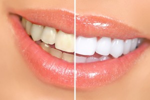 Does Oil Pulling Whiten Teeth?